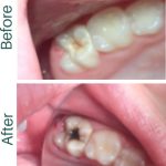before-after-silver-fluoride