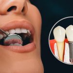 dental-implants